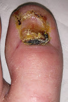 Big Toenail Removal - Left Foot - 6 Weeks & 4 Days