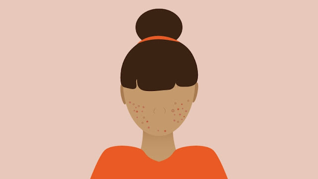 What you need to know how to treat acne