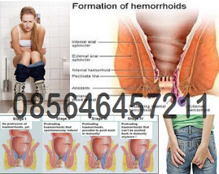 Komplikasi Penyakit Wasir Hemorrhoids