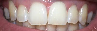 example of my teeth after using the carbon coco kit for 7 nights