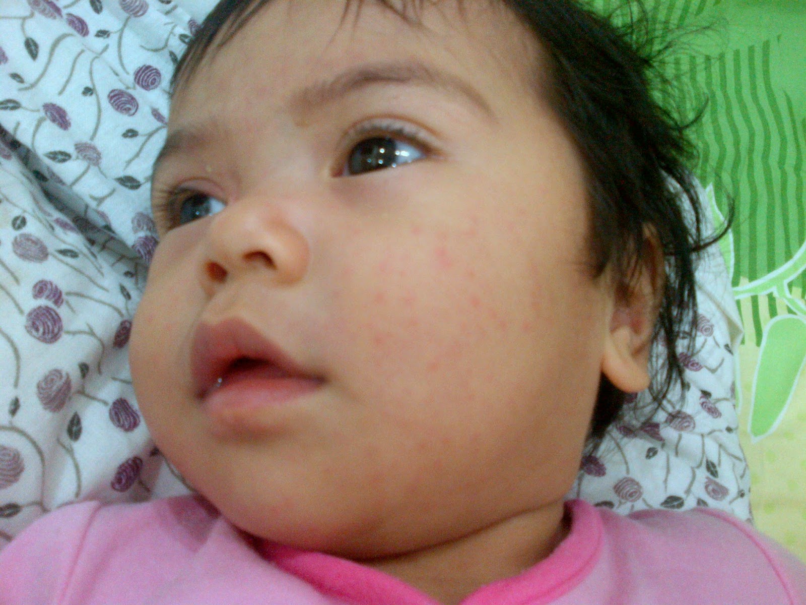 Ayumieka.blogspot.Com: Bila baby kena demam campak