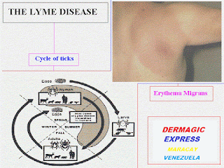 enfermedad de Lyme y lymerix