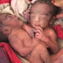 Takjub !!! Lahirnya Seorang Bayi Kembar Siam 2 Kepala 1 Perut di India.