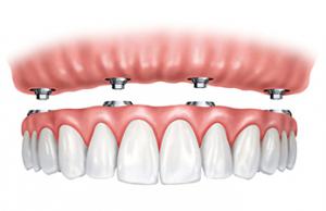 Dr. Frank Roach is Pleased to Offer “All-on-Four” Dental Implants to Patients in the Atlanta Area