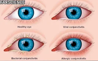 TYPES OF EYE FLU