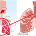 5 Tips Untuk Mencegah Penyakit Pneumonia