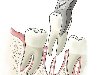 Tooth Extractions West Chester