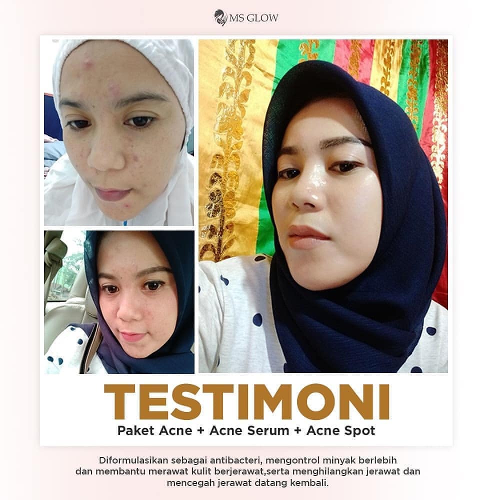 testimoni ms glow skin care