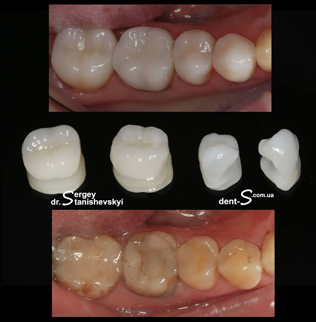 стоматолог стоматология Виниры Киев Станишевский Сергей накладки коронки керамика керамическая реставрации вкладки e-max inlay onlay overlay veneer veneers