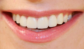 Teeth whitening bleaching and dental care by dentist in Bellevue WA