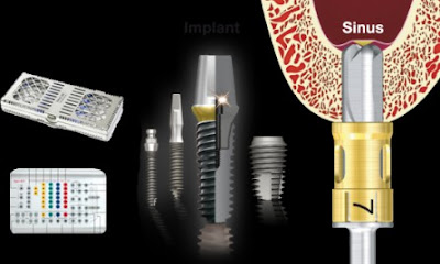 Tác dụng của cấy ghép răng với implant là gì ?