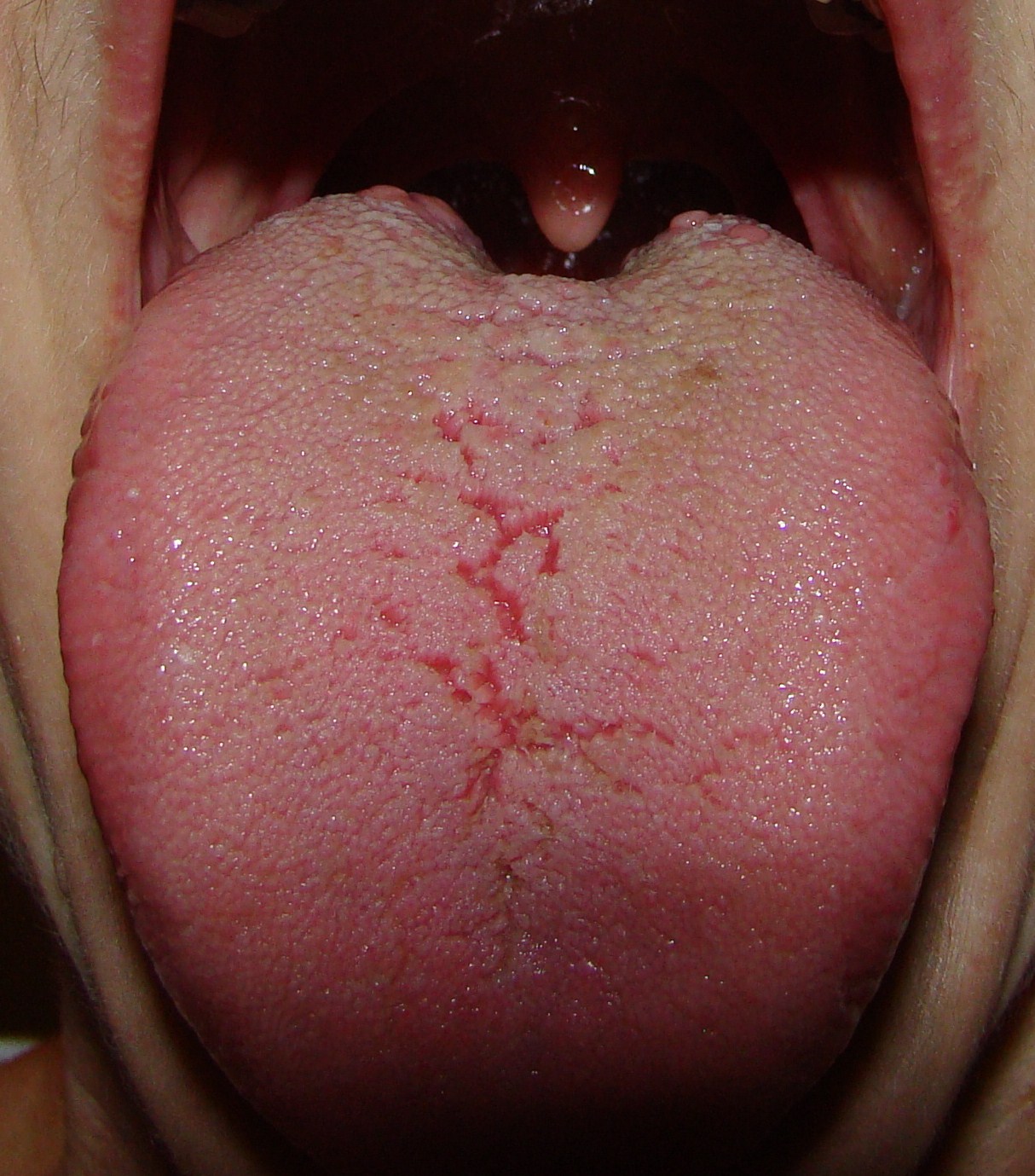 White Bump On My Tongue