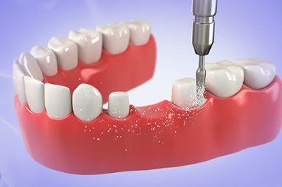 Cầu răng sứ là phương pháp gì?