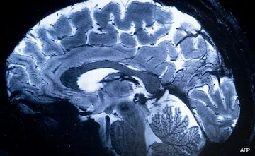 World's Strongest MRI Scanners: The First Images of the Human Brain/दुनिया के सबसे मजबूत एमआरआई स्कैनर मानव मस्तिष्क की पहली छवियां