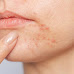 Acne Treatment Options: From Topical to Oral Medications