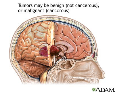 Brain Tumour Symptoms