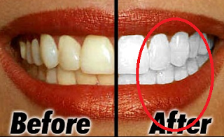 cara gampang buat putih gigi alami cepat