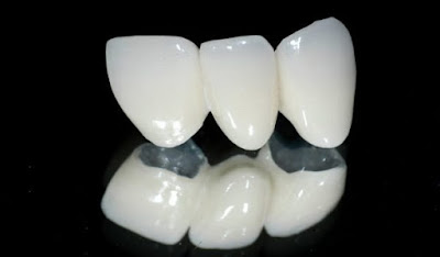 Quy trình bọc mão răng sứ cho răng khểnh