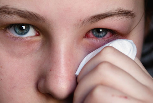 Những nguyên nhân gây ra bệnh đau mắt đỏ