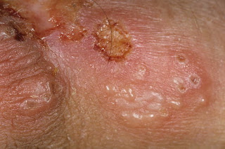 gambar herpes genital