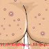 Treatment of Butt Pimples - Hip Pimples Remedies