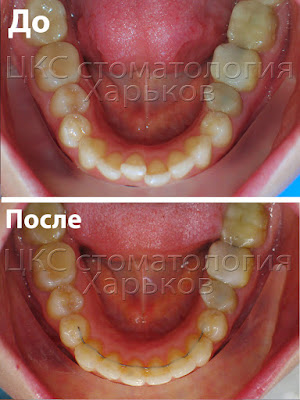 До и после лечения брекетами