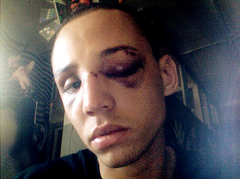 A young gay man was left with two black eyes and multiple stitches after a