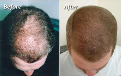 Surgical Hair Restoration