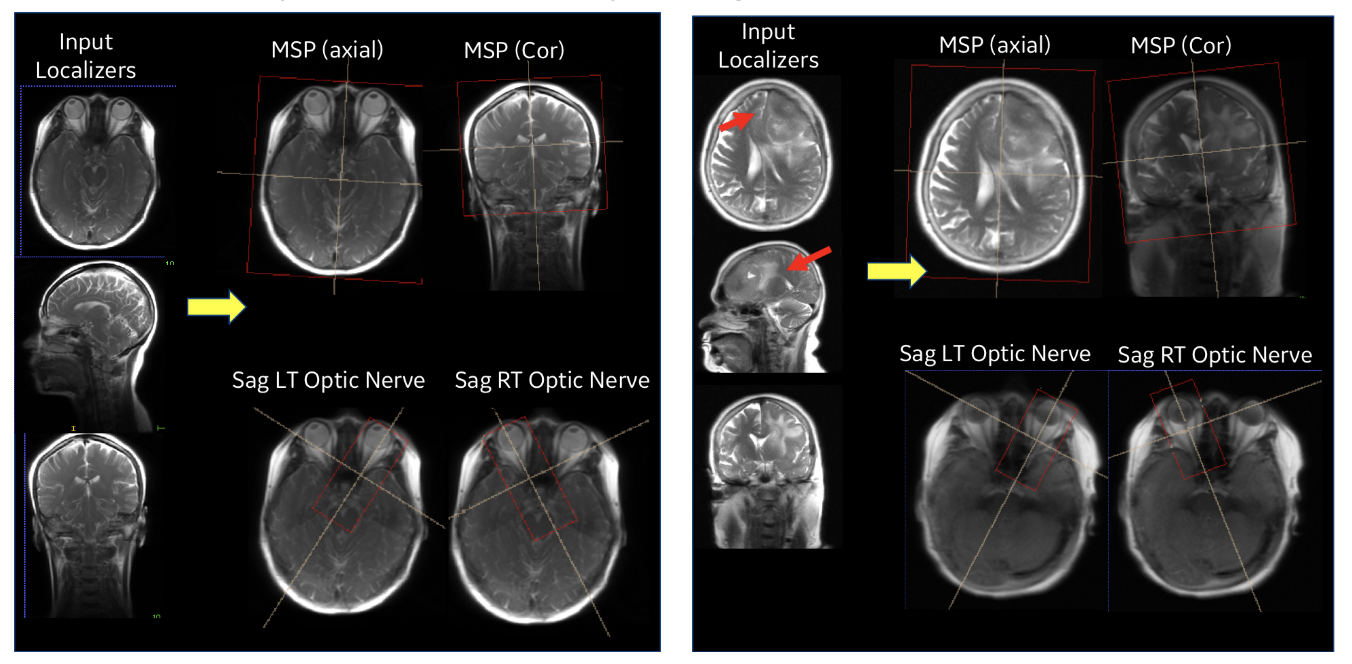 Performance of ISP in a normal subject case (left) and with pathology (right).