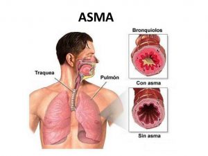 penyakit asma
