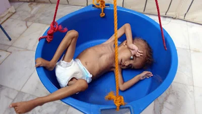 famine au Yémen