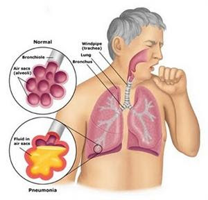 Pengobatan Pada Radang Paru-paru