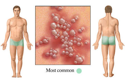 Treatment Of Oral Herpes On Lips : Vaginitis_whiteness