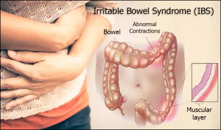 Irritable bowel syndrome