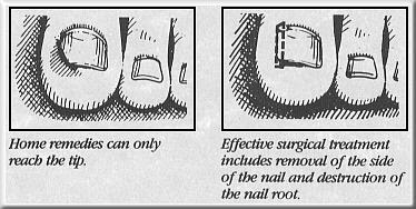 Ingrown toenail diagram.