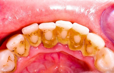  Lấy vôi răng cho trẻ em cần lưu ý gì
