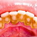  Lấy vôi răng cho trẻ em cần lưu ý gì