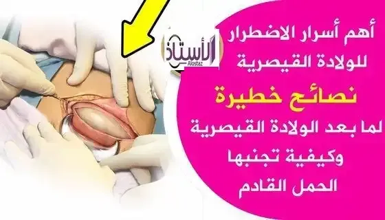 Pregnancy-tips-after-cesarean-delivery