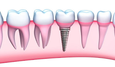 Bạn có biết trồng răng implant ở đâu tốt tại tphcm? 2