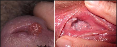 Penyebab Virus Hpv