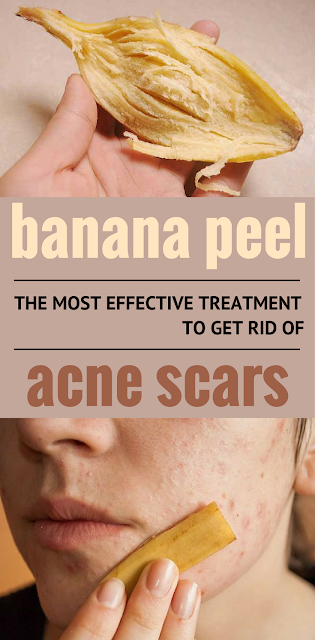 Banana Peel – The Most Effective Treatment to Get Rid of Acne Scars