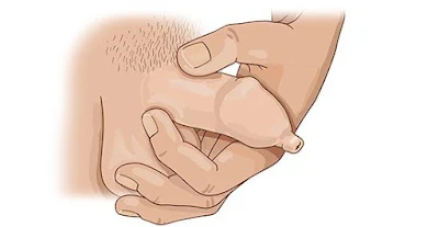 Men with Phimosis Condition