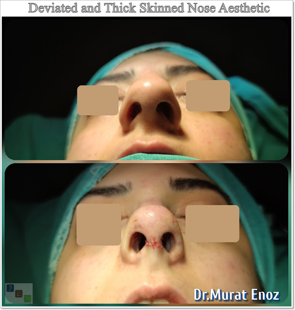 Deviated Nose and Treatment