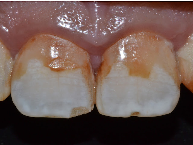 Dental Fluorosis at Jamnagar