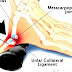 Ulnar collateral ligament injury of the thumb