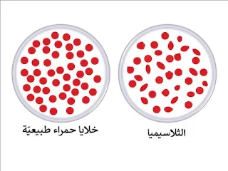 التلاسيمياء والتشافي منها مع dxn