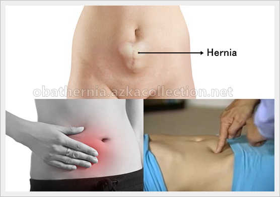 Jenis Hernia Pada Wanita Yang Perlu Anda Ketahui