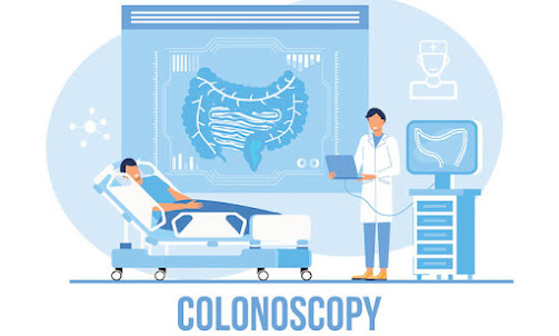 Screening Colonoscopy