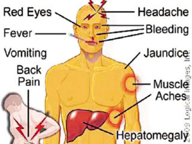 Yellow fever signs and symptoms and hence vaccination is important