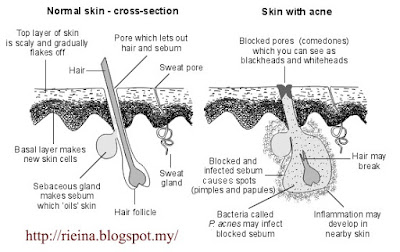 TIPS MENGATASI JERAWAT